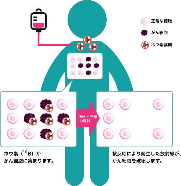 BNCTのしくみ